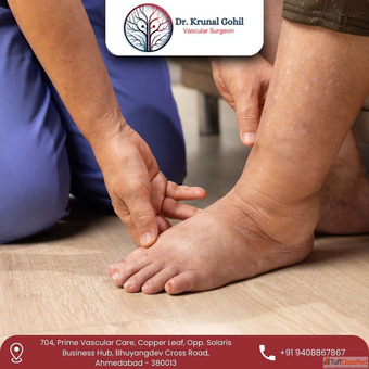 Best Diabetic Foot Treatment in Ahmedabad with 10 Years of Expertise - Dr. Krunal Gohil