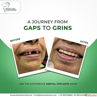 Advanced Dental Fillings in Noida for a Healthy Smile