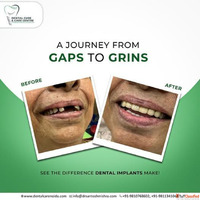 Advanced Dental Fillings in Noida for a Healthy Smile