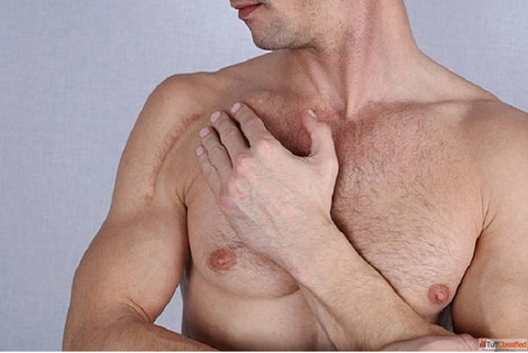 Gynecomastia Surgery in Riyadh