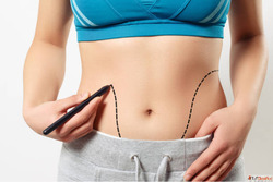 Liposuction in Riyadh