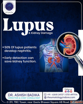 Systemic Lupus Erythematosus Treatment In Indore Dr. Ashish Badika