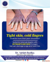 Systemic Sclerosis Care In Indore Dr. Ashish Badika