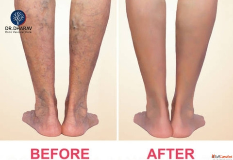 Safe Varicose Veins Treatment by Dr. Dharav Kheradia in MumbaiIndia