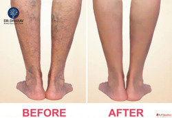 Safe Varicose Veins Treatment by Dr. Dharav Kheradia in Mumb...