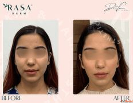 Aqualyx injections rasaderm