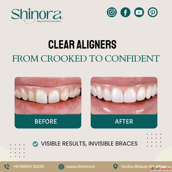 Trusted Invisible Aligners Clinic in Ahmedabad - Shinora