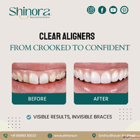 Trusted Invisible Aligners Clinic in Ahmedabad - Shinora
