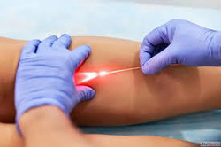 Consult the Best Doctor for Varicose Veins - Expert Care Adv...