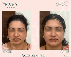 Cosmelan peel price Delhi
