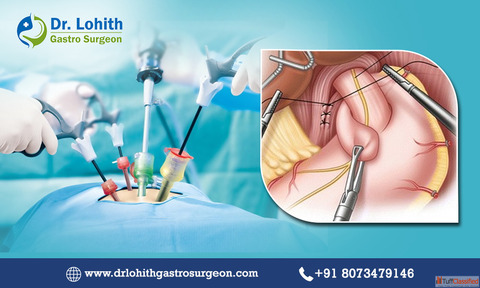 Expert Laparoscopic Fundoplication Surgery Specialist in Sarjapur Road - Dr. Lohith U
