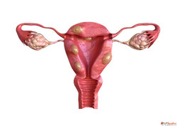 Dr. Dharav Kheradia - Leading Uterine Fibroids Treatment Doc...