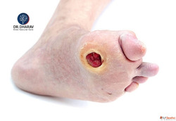 Dr. Dharav Kheradia Expert Diabetic Foot Surgeon Offering Ad...