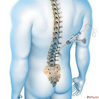 Endoscopic Spine Doctor in Lucknow - Dr. Sandeep Kesharwani