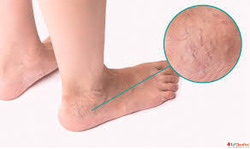 Best Doctor for Varicose Veins - Expert Care for Lasting Rel...