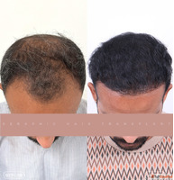 Hair Specialist in Indore Expert Hair Loss Restoration