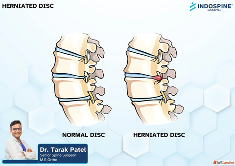 Dr. Tarak Patel- Herniated Disc Treatment in Ahmedabad
