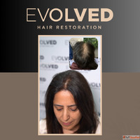 hair implant in delhi