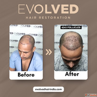 hair transplant cost gurgaon