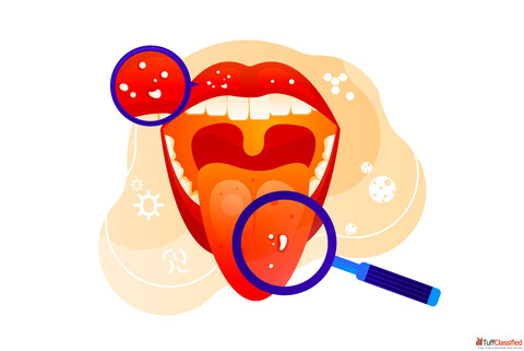 Natural Relief with Mouth Cancer Treatment in Homeopathy