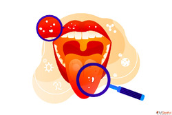 Natural Relief with Mouth Cancer Treatment in Homeopathy