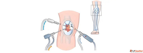 Affordable Arthroscopy Surgery in Ahmedabad - Experienced Specialists