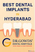 Best Dental Implants in Hyderabad with Dr. Gowd Dental Hospi...