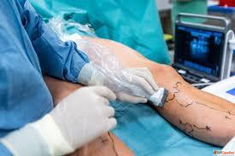 Best Hospital for Varicose Vein Treatment in India