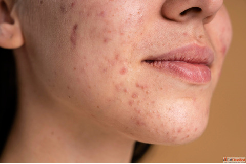 Best Homeopathic Remedies For Hyperpigmentation DR. Ankur Prakash