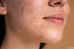 Best Homeopathic Remedies For Hyperpigmentation DR. Ankur Pr...