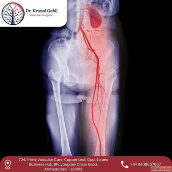 Dr. Krunal Gohil Expert in Best Peripheral Arterial Disease Treatment in India