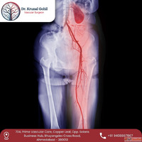 Dr. Krunal Gohil Expert in Best Peripheral Arterial Disease ...