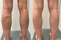Discover the Best Hospital for Varicose Vein Treatment in In...