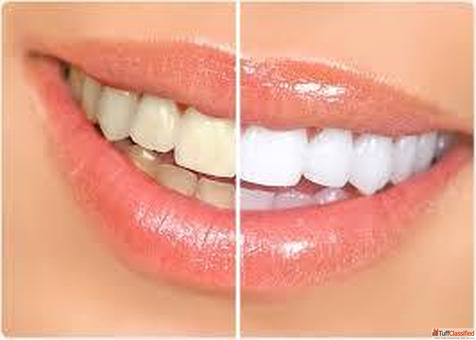 Teeth Whitening In Gurgaon