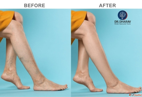 Dr. Dharav Kheradia - Best Varicose Veins Treatment Doctor in Mumbai India