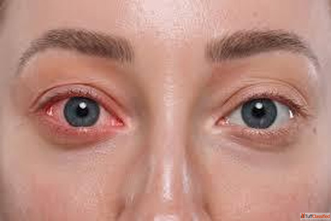 Conjunctivitis Treatment in Homeopathy for Healthy Eyes