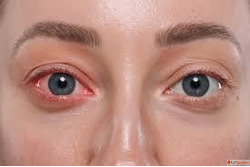 Conjunctivitis Treatment in Homeopathy for Healthy Eyes
