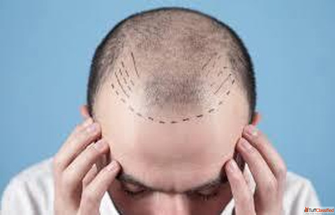 Best Hair Transplant in Ahmedabad Gujarat - Natural Results by Dr. Krupa