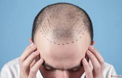 Best Hair Transplant in Ahmedabad Gujarat - Natural Results ...