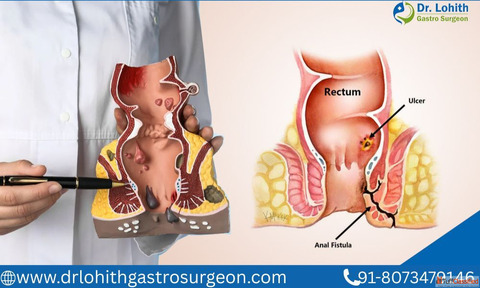 Fistula Treatment in Bangalore by Dr. Lohith U