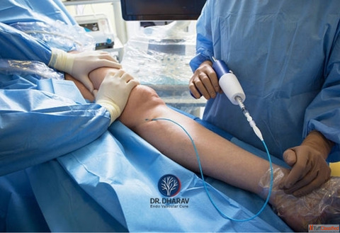 Advanced Varicose Veins Treatment in MumbaiIndia by Dr. Dharav Kheradia