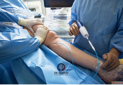 Advanced Varicose Veins Treatment in MumbaiIndia by Dr. Dhar...