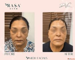 Hydrafacial Treatment in Delhi - Reveal Your Natural Glow