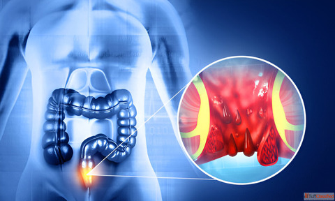 Piles Treatment in Kharghar