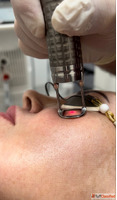 Proctology Laser Machine Manufacturers - Phoxton Best Offers...