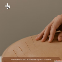 Acupuncture Calgary Natural Healing and Pain Relief at South...
