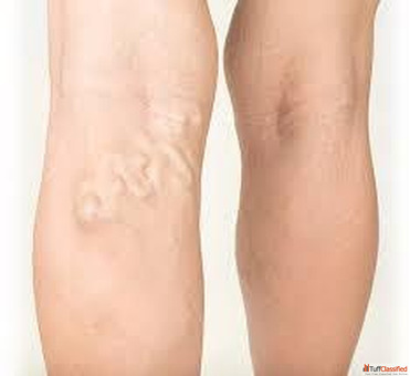 Best Hospital for Varicose Vein Treatment in India - Advanced Care for Lasting Relief