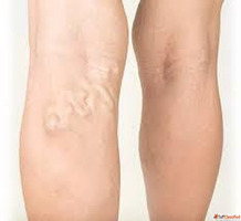 Best Hospital for Varicose Vein Treatment in India - Advance...