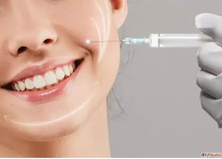 Smile Line Fillers in Gurgaon for a Youthful Glow