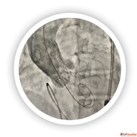 BMV Procedure